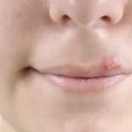 Understanding Cold Sores on the Lips